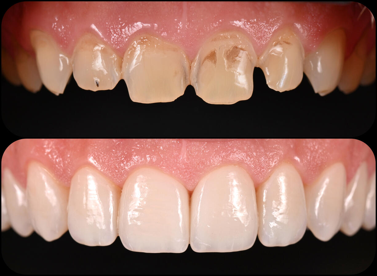 Porcelain Veneers – Restoring a Worn and Damaged Smile A bespoke smile transformation using ceramic veneers to restore worn, fractured and discoloured anterior teeth, improving aesthetics, symmetry and function while maintaining a natural appearance. Before and after clinical photographs showing a smile restored with porcelain veneers to replace worn, fractured and discoloured upper front teeth, creating a natural, harmonious appearance.